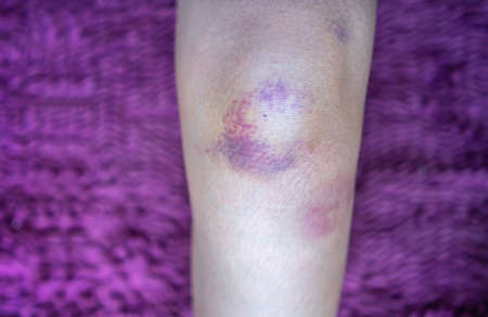 Close up bruise damage on knee of woman.の写真素材