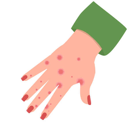 vector illustration of a hand with spots of eczema or contact dermatitis, isolated on a white backgroundのイラスト素材