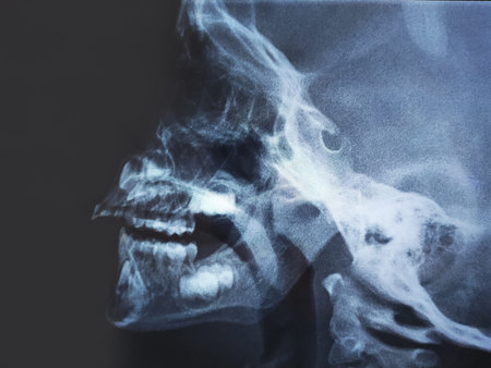 Grade III adenoid hypertrophy in the nasopharynx of a child