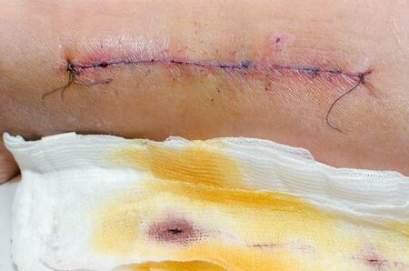 Suture on a damaged leg after surgery. Close-up.の写真素材