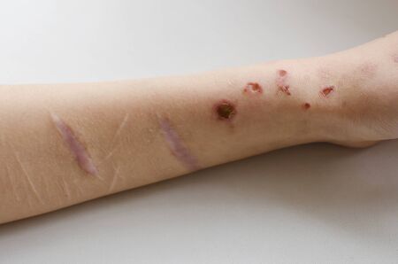 female hand with cuts after suicide attemptの写真素材
