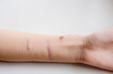 Scars on the arm, close-up.の写真素材