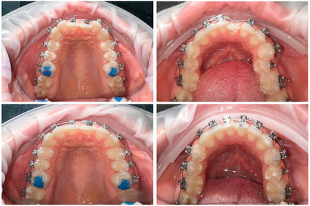Close-up photo before and after braces are installed. Upper and lower jaw.の写真素材