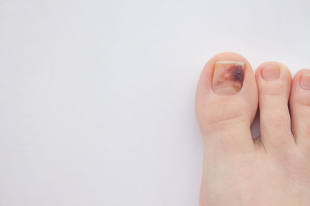 black hematoma on the nail closeup on a white background. blue toe nail. flat lay.