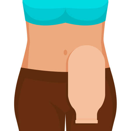 Young woman with colostomy bag. Vector illustrationのイラスト素材