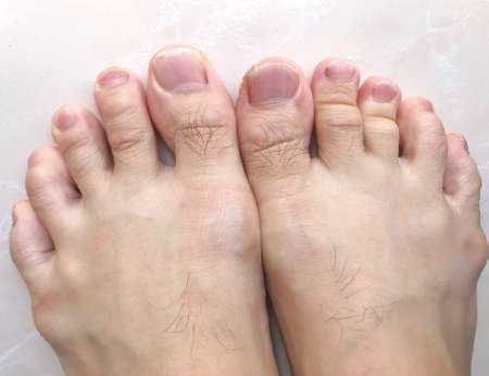 Male bare feet with crooked toe finger standing on tile floor.の写真素材