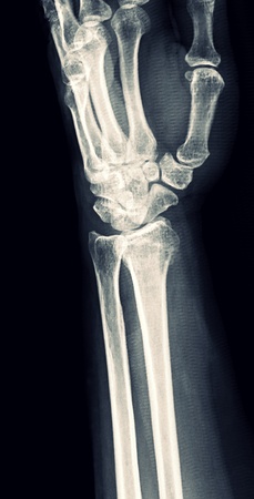 X-ray Wristの写真素材