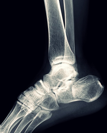 X-ray Foot Ankle Calcaneusの写真素材
