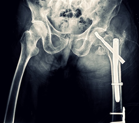X-ray Hip Pelvis