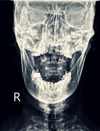 X-ray Cervical Spine Neckの写真素材