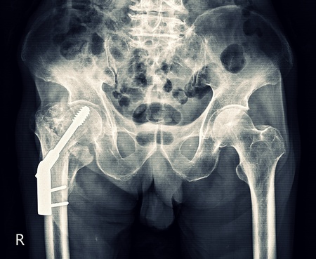 X-ray Hip Pelvisの写真素材