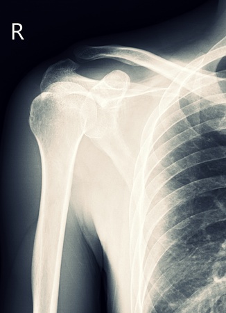 X-ray Shoulder Clavicleの写真素材