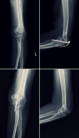 X-Ray Fracture Elbow Before and After Treatmentの写真素材