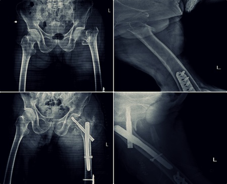 X-Ray Fracture Hip and Femur Before and After Treatmentの写真素材