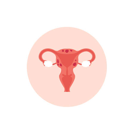 Female reproductive system with adenomyosis, enlarged uterus icon. Flat vector cartoon modern...