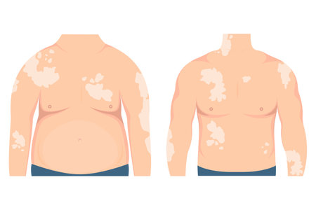 Fat and thin man with vitiligo patches on the skin. Beauty diversity concept, body positive, chronic skin disease awareness, illustrationのイラスト素材