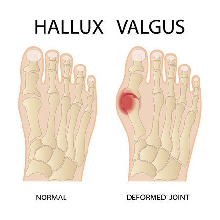 Hallux valgus medical infographic. vector illustrationのイラスト素材