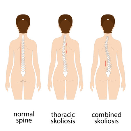 Spine deformation types and healthy spine comparison diagram poster with backbone curvatures. Female profile and back view. Chiropractic informationのイラスト素材