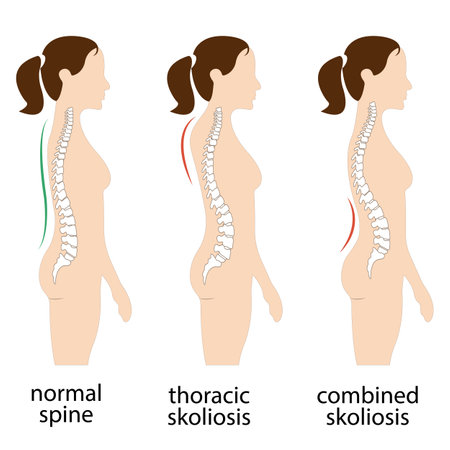 Spine deformation types and healthy spine comparison diagram poster with backbone curvatures. Female profile and back view. Chiropractic informationのイラスト素材