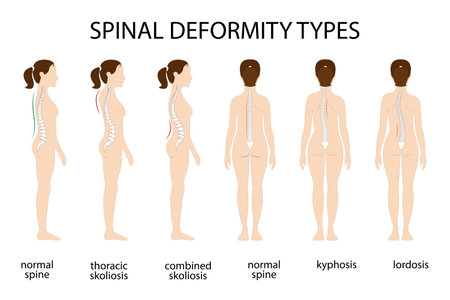 Spine deformation types and healthy spine comparison diagram poster with backbone curvatures. Female profile and back view. Chiropractic informationのイラスト素材