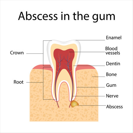 medical infographic template and tooth anatomy.abscessのイラスト素材