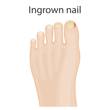 illustration of healthy feet, feet with ingrown toenails, treatment of ingrown toe and toeのイラスト素材