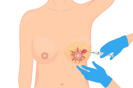 Breast cancer diagnostic biopsy to obtain a sample by an experienced physician in a medical clinicのイラスト素材
