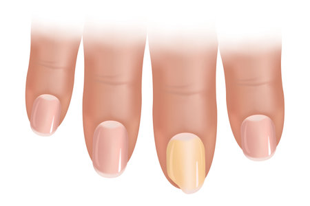 Nail diseases, onycholysis, fungal nail infections. Damaged yellow and green human nails.Nail fungusのイラスト素材
