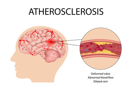 Anatomy of a person with atherosclerosis stroke. Atherosclerosis of the blood vessels of the brainのイラスト素材