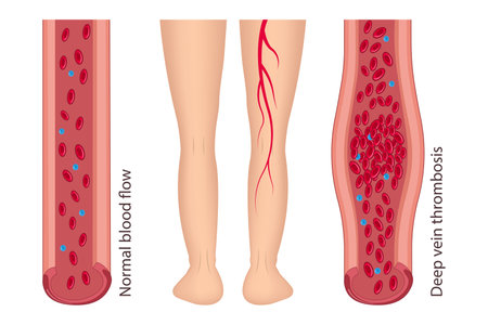 Medical diagram of deep vein thrombosis in the leg area. Illustration of blood flow disorderのイラスト素材