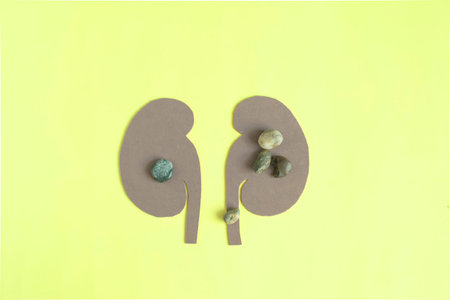 Kidney disease associated with kidney stones on a light background.の写真素材