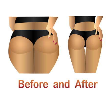 Woman's body before and after fitness,yoga. Cellulite versus smooth skin. Cellulite, Fat on belly.のイラスト素材