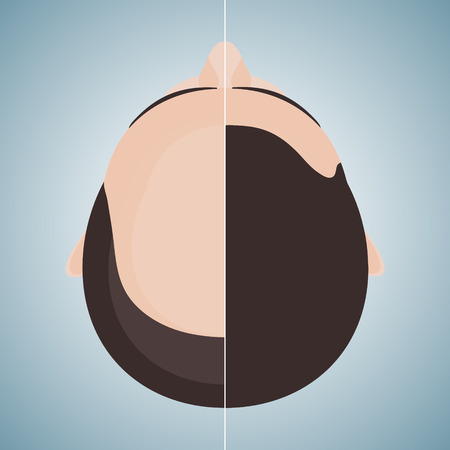 Top view portrait of a man before and after hair treatment and hair transplantation. Divided image of a head. Two halves. Hair care concept. Isolated vector illustration.のイラスト素材