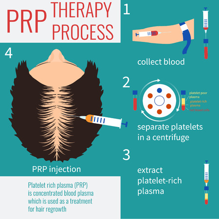 Platelet rich plasma injection. PRP therapy process. Hair loss treatment. Injection. Mesotherapy. Hair growth stimulation. Transplantation of hair.のイラスト素材