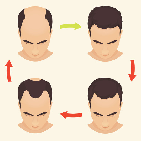 Male hair loss stages set. Man before and after hair treatment and hair transplantation. Male pattern baldness. Transplantation of hair. Vector illustration.のイラスト素材
