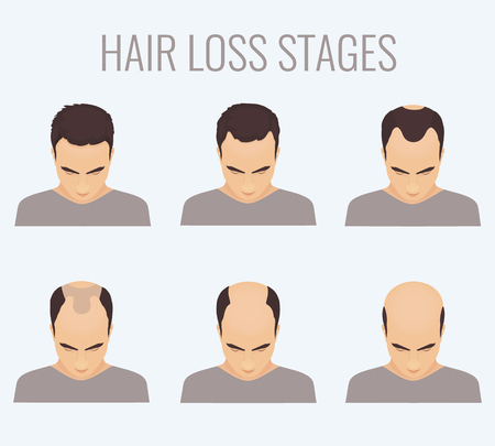 Male hair loss stages set. Top view portrait of a man losing hair. Male pattern baldness. Transplantation of hair. Signs of balding. Frontal hair loss. Vector illustration.のイラスト素材