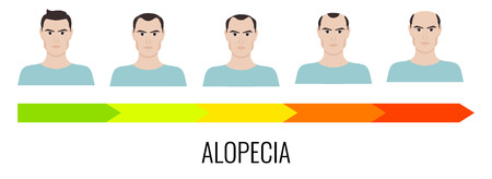 Alopecia stages set. Front view of a man losing hair. Male baldness. Male hair loss pattern. Human hair growth. Hair care concept. Vector illustration.のイラスト素材