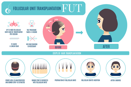 FUT hair transplantation for women Vector illustration.のイラスト素材