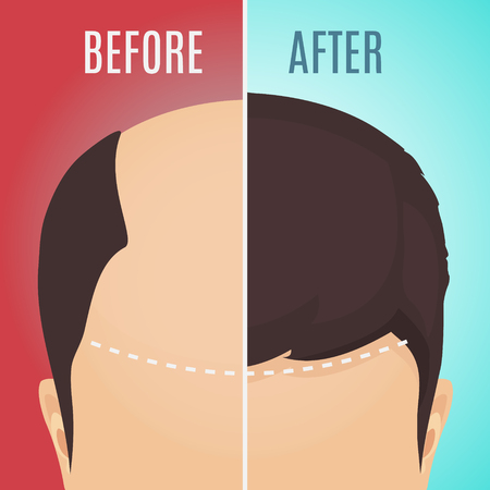 Top view portrait of a man before and after hair treatment and transplantation. Divided image of the head on red and blue background. Two halves. Vector illustration.のイラスト素材