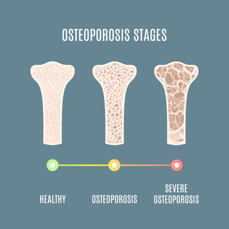Osteoporosis process infographic of bone tissue close-up with different density. Skeletal system...