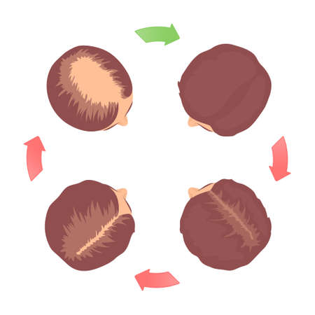 Female-pattern hair loss 4 stages set with head in top view. Classification of baldness in women in round chart with circular arrows. Androgenetic alopecia medical infographic. Vector illustration.のイラスト素材