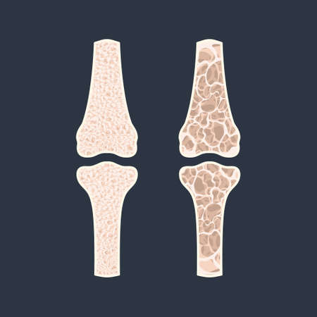 Bone density loss disease infographic banner. Normal bone vs osteoporotic bone. Health care and...