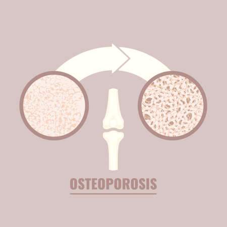 Normal bone after mass loss process caused by osteoporosis.  Close-up of normal femur cavity tissue and osteoporotic texture. Skeletal system disease. Senior osteopathy medical vector illustration.のイラスト素材