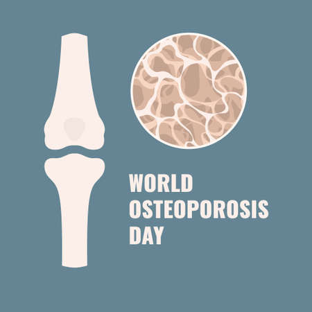 Osteoporosis awareness poster. Porous bone losing tissue. Spongy femur cavity with osteopenia. Hips,...