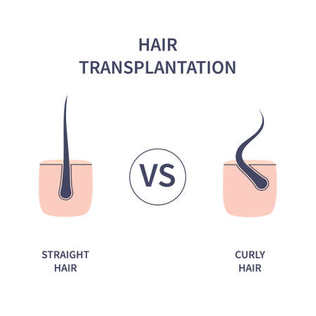 Hair transplantation for different hair types. Skin cross-section with straight and curly strands. Human hair growth style chart. Health care and beauty concept. Vector illustration.のイラスト素材