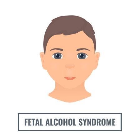 Fetal alcohol syndrome facial features in a childのイラスト素材