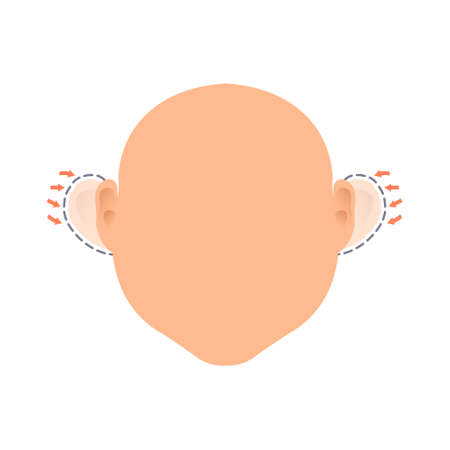Before and after otoplasty ear surgery treatmentのイラスト素材
