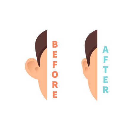 Man before and after otoplasty ear surgery treatmentのイラスト素材
