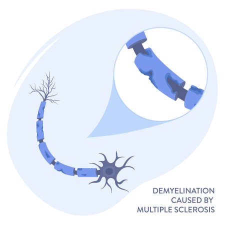 Nerve cell demyelination process medical infographic poster