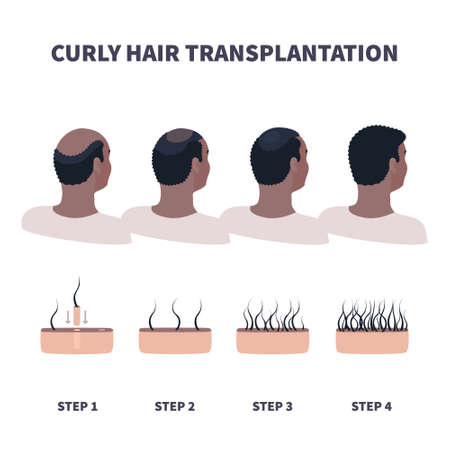 Afro-textured hair transplantation surgery result infographics. African male patient before and after hair loss treatment with FUT, FUE methods. Treating alopecia medical poster. Vector illustration.のイラスト素材
